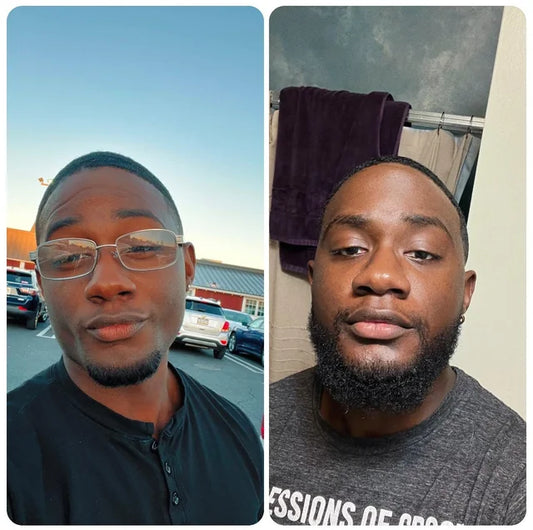 L’histoire de Marcus : de joues nues à barbe complète